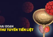 Tại Sao Cần Tầm Soát Ung Thư Tuyến Tiền Liệt Sớm Ở Nam Giới!