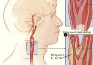 TẠI SAO CHÓNG MẶT HOẶC CHOÁNG VÁNG KHI ĐỨNG LÊN?
