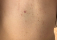 Tại Sao Mùa Hè Làm Tăng Nguy Cơ Nhiễm Giun Sán?