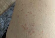 TÔI KHÔNG NGỜ ĐẾN MÌNH CŨNG BỊ NHIỄM SÁN CHÓ