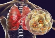 Tổng Quan Về Các Triệu Chứng Của Rối Loạn Phổi