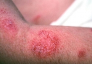 Tổng Quan Về Nhiễm Trùng Da Do Vi Khuẩn