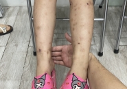 Trẻ Ngứa Da Kéo Dài: Cảnh Giác Ấu Trùng Giun Đũa Chó Mèo