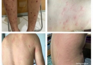 Triệu Chứng Bệnh Giun Đũa Chó Mèo