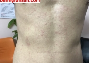 TRIỆU CHỨNG GIUN SÁN CHÓ MÈO