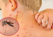 SỐT XUẤT HUYẾT - NHỮNG LƯU Ý VÀ CHĂM SÓC TRẺ BỊ NHIỄM