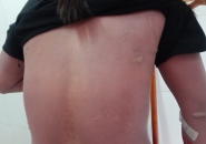 TOÀN THÂN BỊ LOÉT DO TẮM LÁ CÂY