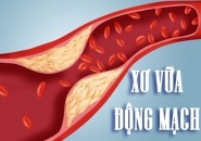 ĐỘT QUỴ CÓ THỂ XẢY RA BẤT CỨ LÚC NÀO KHI BỊ XƠ VỮA  MẠCH MÁU