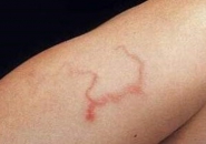 XÉT NGHIỆM BỆNH GIUN LƯƠN