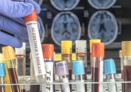 98% CÓ THỂ PHÁT HIỆN BỆNH ALZHEIMER KHI XÉT NGHIỆM MÁU