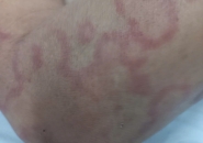 Vì Sao Ngứa Dạng Vòng Kéo Dài Không Khỏi? Bác Sĩ Giải Đáp