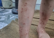 Vì Sao Trẻ Dễ Nhiễm Giun Sán Vào Mùa Hè?