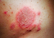 VIÊM DA ĐỒNG TIỀN