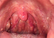 VIÊM HỌNG HẠT LÀ GÌ ? NGUYÊN NHÂN VÀ CÁCH ĐIỀU TRỊ