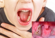 VIÊM HỌNG GÂY THẤP TIM