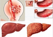 TÁC HẠI CỦA RƯỢU BIA ĐẾN GAN NHƯ THẾ NÀO ? 